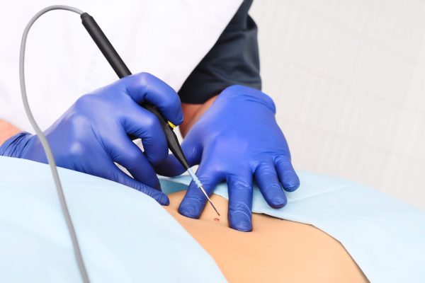 A dermatologist surgeon removes a mole or nevus on a woman's abdomen with a radio knife in close-up. Prevention and diagnosis of melanoma.
