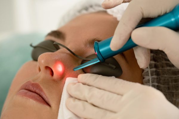 Woman client during laser mole removal in a medical aesthetic clinic