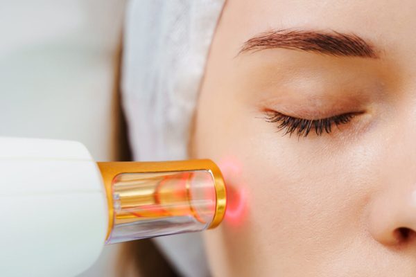 Removal of small vessels on patient face with laser equipment. Laser treatment of rosacea with IPL equipment by beautician