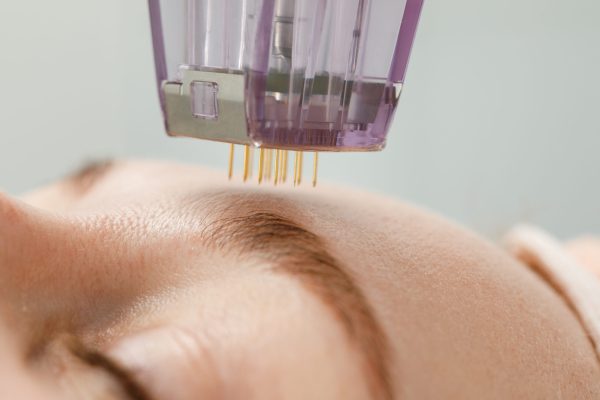 Microneedle mesotherapy. Woman receiving micro needling rejuvenation treatment in a cosmetology clinic